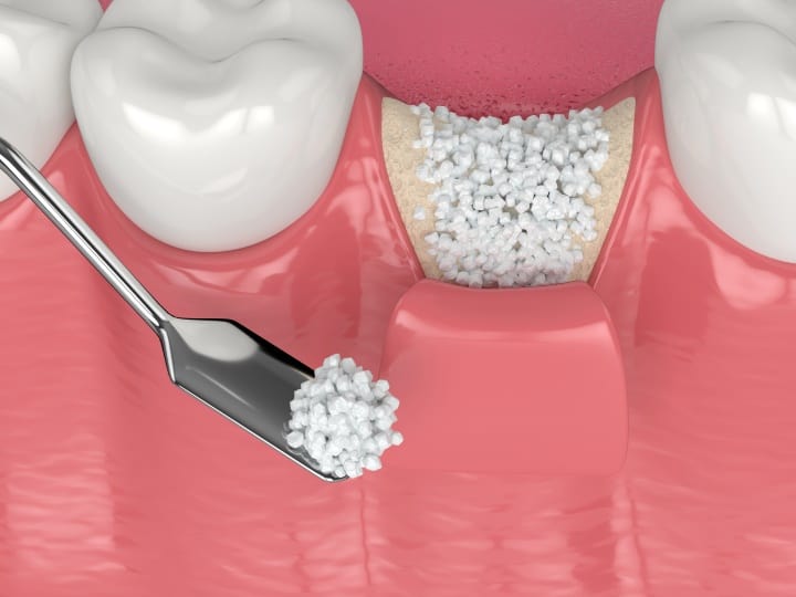 dental-implants-bone-augmentation