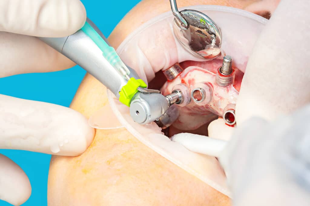 dental-implants-complications
