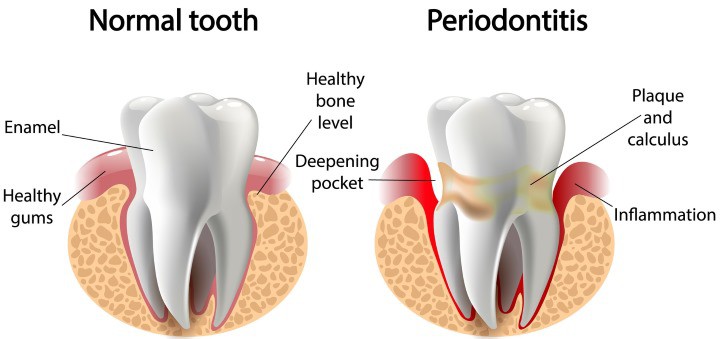 Introduction to Periodontitis