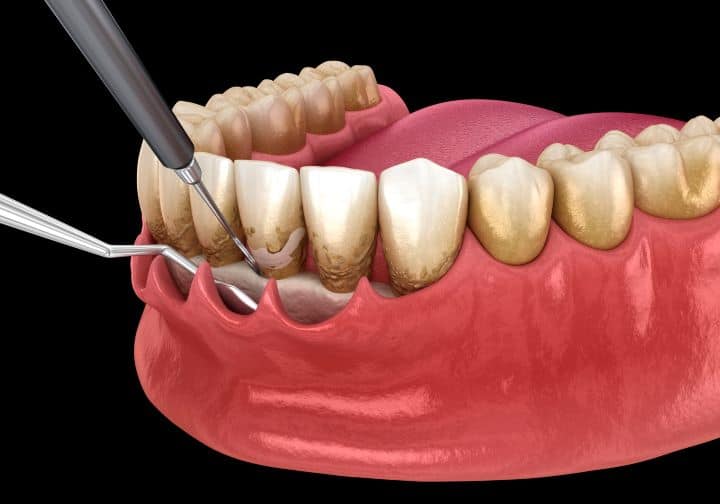 Tooth Scaling & Polishing