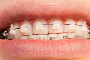 Teeth Braces for Adults