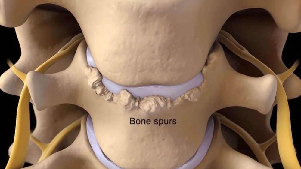 Bone Spurs in body