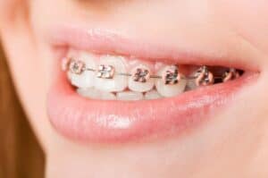 Dental Braces: Everything About Braces, Type of Braces, and Care