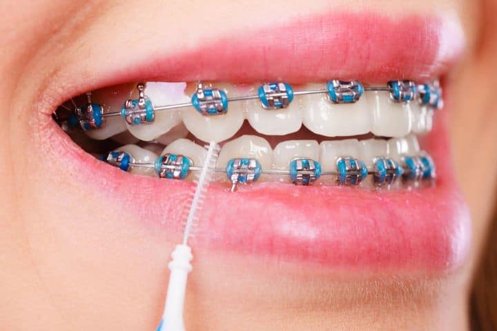 Self-ligating braces