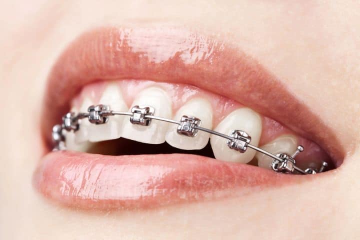 Metal Teeth Braces for Adults