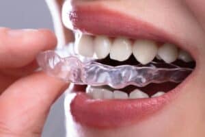 Invisalign Aligners: Pros and Cons of Invisalign Braces for Straightening Your Teeth