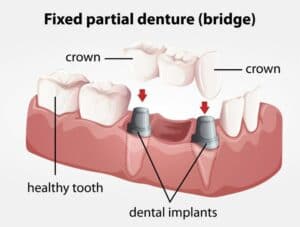 Dental Bridges Vs. Implants