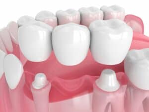 Dental Bridges: An Overview of the Four Types of Dental Bridges