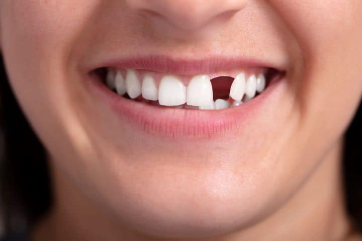 Teeth Gap Filled