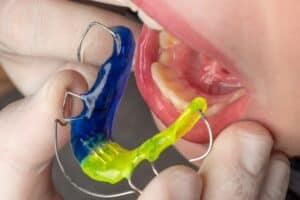 Hawley Retainer: It’s Role in Orthodontic Treatment, a Comprehensive Guide