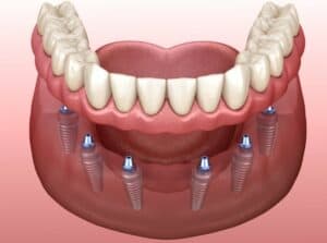 Implant-Supported Dentures: Benefits, Process, Cost, and Care of Implant-Supported Dentures