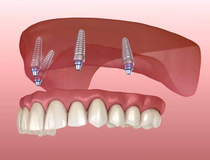Implant retained denture fitting