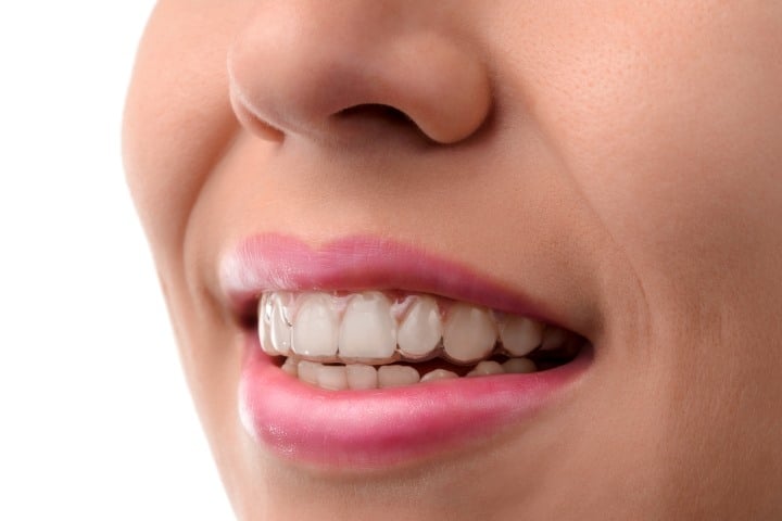 Clear Aligners or Invisible Braces: Everything You Need to Know About Clear  Braces 