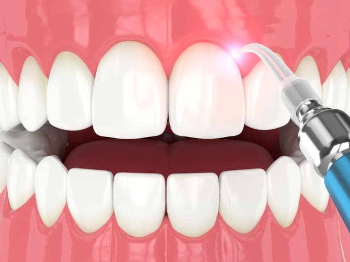 Gum Surgery with Laser