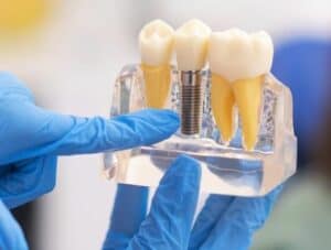 Mini Dental Implants: A Guide to MDIs, Cost, Pros and Cons