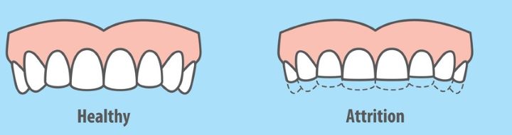 Teeth Grind