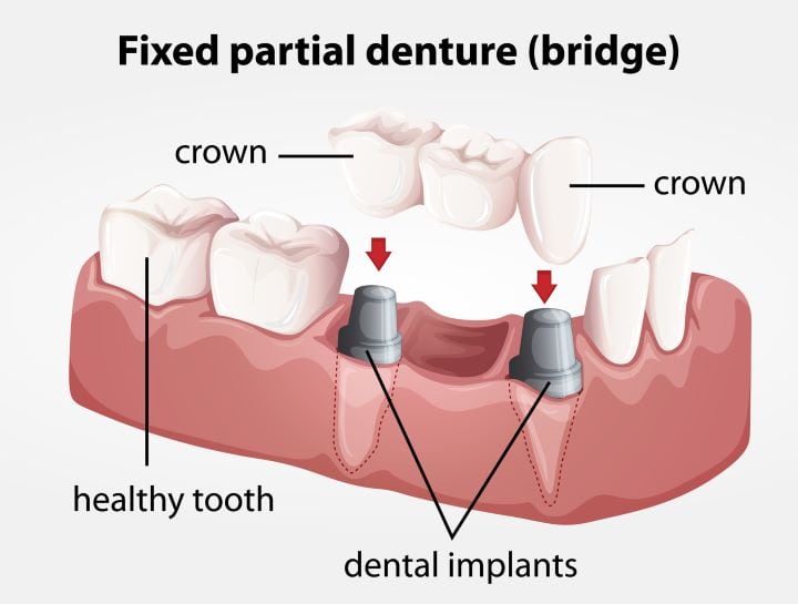 resto-Dentures