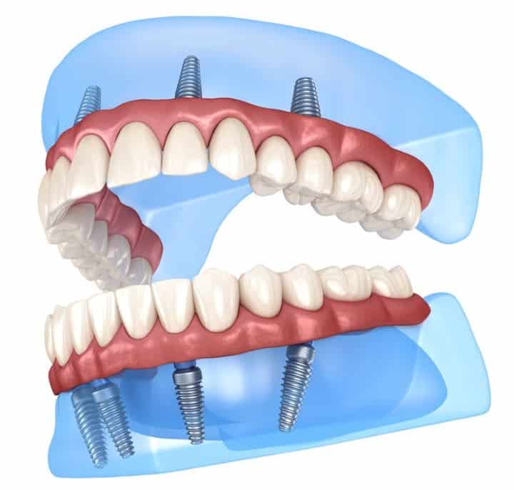 All-on-4 Dental Implants
