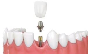 Same-Day Dental Implants: Pros, Cons, Prices and an Overview