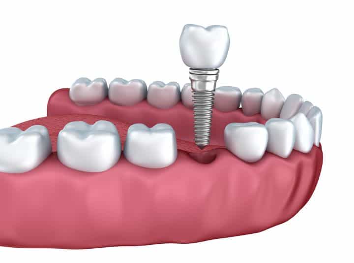 Same-Day Dental Implants Work