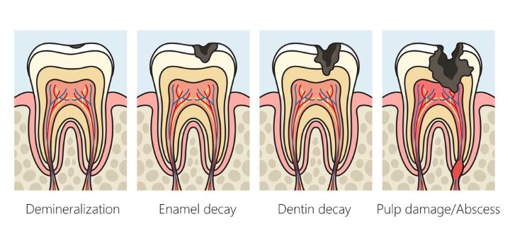 Stages of Tooth Decay 
