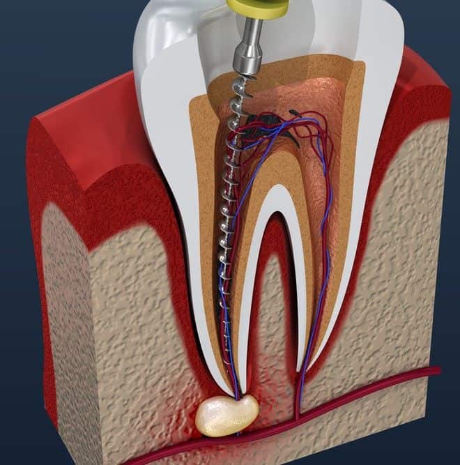 Periapical abscess formation