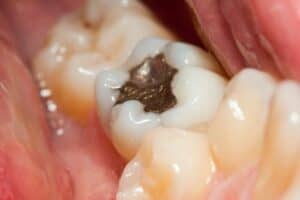 What To Do When Your Tooth Filling Falls Out