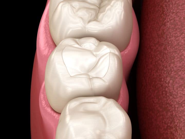 Tooth restoration