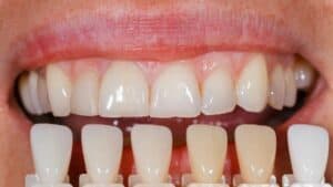 Dental Veneers: How Much Do Veneers Cost? Factors, Prices, and Financing Options Explained