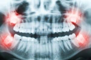 Understanding Wisdom Teeth: A Comprehensive Guide to Definition, Common Issues & Tooth Extraction