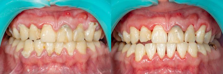 Duration and recovery after full-mouth debridement