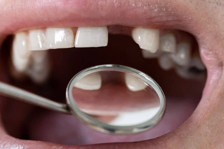 loose teeth in adults