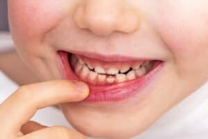 Loose Tooth: Causes, Risks, and What to Do When Teeth Are Loose