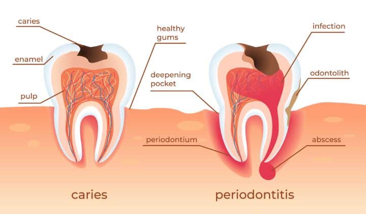 Causes of Dental Abscess