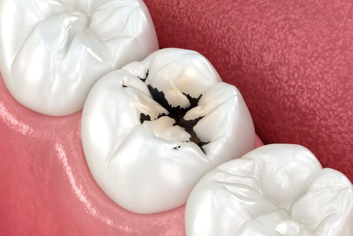 Dental Fillings: Types