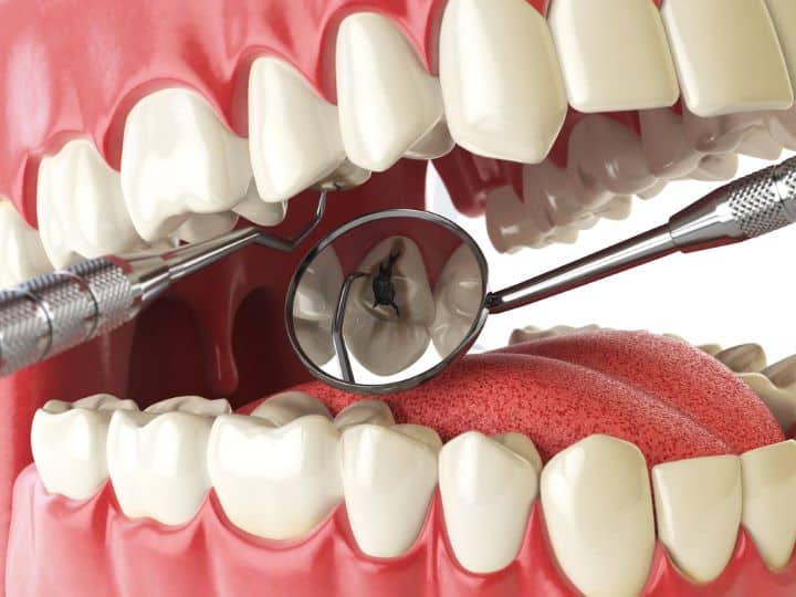Dental filling procedure