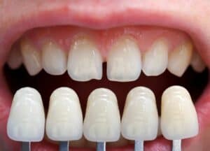 Dental Veneers: Types, Benefits, Cost and the Process Explained