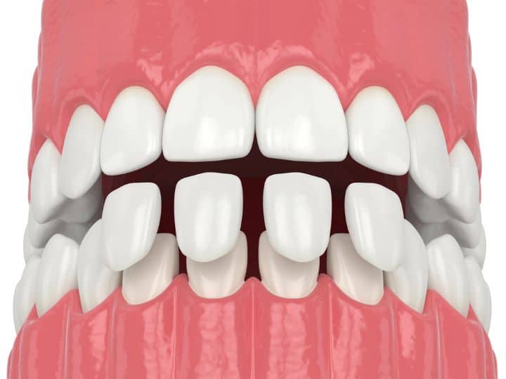 The Process of Getting Dental Veneers