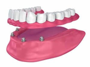 Implant-Retained Dentures vs. Conventional Dentures: Everything About Them
