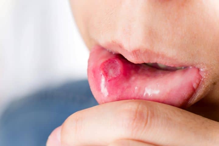 Symptoms of mouth ulcers: 