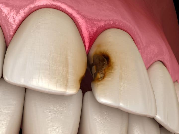 Internal Tooth Resorption