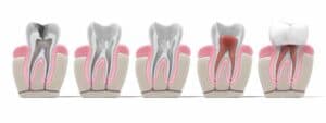 Root Canal Treatment:  Saving Your Tooth and Relieving Dental Pain